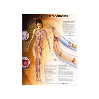 Süvaveenitromboos (DVT) - plakat