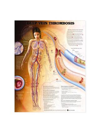 Süvaveenitromboos (DVT) - plakat
