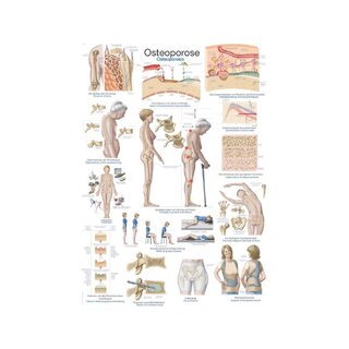 Poster Osteoporoos, Anatoomiline poster 50x70cm