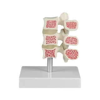 Osteoporoosi selgroolüli mudel, 3 selgroolüli