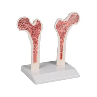 Osteoporoos Reieluu